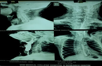 barium-swallow barium-swallow