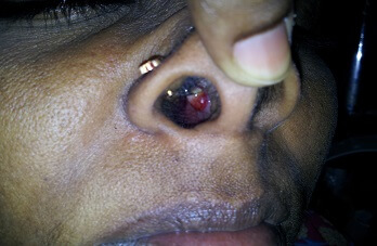 bleeding-polypus-nose bleeding-polypus-nose