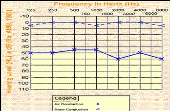 conductive-hl-audiogram conductive-hl-audiogram