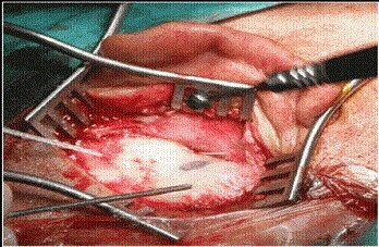 mastoidectomy mastoidectomy