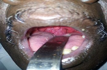 oropharyngeal-rhinosporidiosis oropharyngeal-rhinosporidiosis